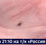 Смотрите в 21:10. Первый случай клещевого энцефалита зарегистрирован в Хабаровском крае - ГТРК Дальневосточная
