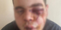 Сотрясение мозга вместо шаурмы получил 23-летний мужчина в Воронежской области - Bloknot-Voronezh.Ru