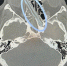 Мужчина полтора года прожил с 12-сантиметровой веткой в голове - ИА Грозный-информ