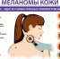 melanoma 0 - Керченская больница №1