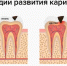 4 июня – Всемирный день борьбы с кариесом (Международный день был учрежден по инициативе стоматологов с 2013 года - Противотуберкулезный диспансер