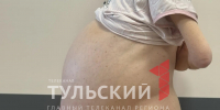 Женщина из Ефремова несколько лет ходила с 35-килограммовой опухолью - ТК Первый Тульский