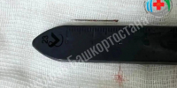 В Башкирии врачи извлекли иглу из стопы полуторагодовалого пациента - ProUral.Info