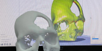 В Кирове хирурги начали печатать кости на 3D-принтер - Kirov.Online
