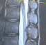 Воронежец лишился части позвонка ради возможности ходить - Bloknot-Voronezh.Ru