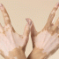young woman showing her vitiligo skin parts - ГБУЗ КО КОККВД