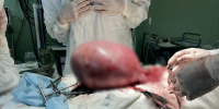 Опухоль размером с арбуз удалили 22-летней жительнице Воронежа - Bloknot-Voronezh.Ru