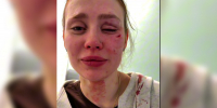 В Воронеже полиция забрала из больницы документы избитой у караоке-бара девушки - ГТРК Воронеж