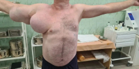 Лебедянские хирурги избавили пациента от двух гигантских опухолей на груди и руке - Gorod48.ru