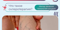 Знаете ли Вы, что такое склеротерапия - КБ №8 ФМБА России
