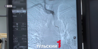 Врачи в Туле начали проводить стентирование сонных артерий - ТК Первый Тульский