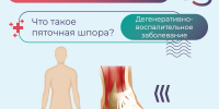 Пяточная шпора: симптомы, профилактика и лечение - КБ №8 ФМБА России