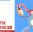 ВПЧ и рак шейки матки - КГБУЗ ККЦМП
