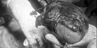 Подмосковные врачи удалили девочке из грудной клетки гигантскую опухоль - РТВ-Подмосковье