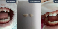 В Воронеже 7-летний ребенок упал с самоката и сломал передние зубы - РИА Воронеж