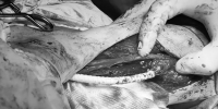 Уникальная операция на сосудах спасла руку 76-летнего рязанца - РИА 7 Новостей