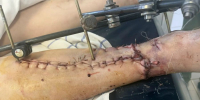 Орловчанка едва не лишилась ноги из-за неосторожности мужа - РИА 57