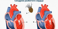 Синдром разбитого сердца: что это такое? - Городская больница им. Архиепископа Луки