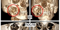 Врачи МОНИКИ восстановили нижнюю челюсть пациента, используя фрагмент малоберцовой кости - ГБУЗ МО МОНИКИ