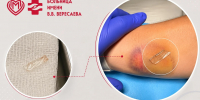 Полтора сантиметра стекла в руке — и ни одной травмы в памяти - ГБУЗ ГКБ им. В.В.Вересаева ДЗМ