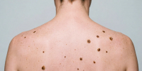 Онколог предупредила о скрытой опасности родинок, которую многие замечают слишком поздно - MosRegToday.Ru