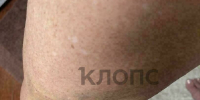 На ноге у женщины остался синяк | Фото: Тамара - Klops.Ru