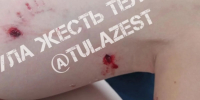 Жители Красного Яра в Киреевском районе сообщили о нападении собак на ребенка - ИА Тульские новости
