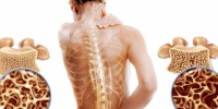 osteoporoz - Министерство здравоохранения