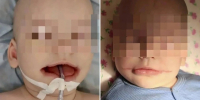 Без возможности нормально дышать и есть: в Уфе родился малыш с редкой патологией лица - Комсомольская правда