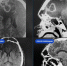 Самолечение при насморке довело 21-летнего парня до трепанации черепа - МОЁ! Липецк