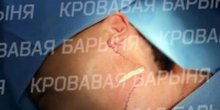 Фото: скриншот | В Приморье врачи удалили гигантскую опухоль с лица пациентки, сохранив ей мимику - PrimPress.Ru