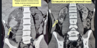 От комы до разрыва почки – как травмируются упавшие с электросамокатов дети - Минздрав