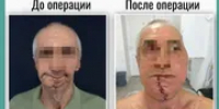 В Башкирии пациенту полностью восстановили челюсть после удаления рака - Башинформ
