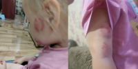19 укусов нашли на теле 3-летней малышки в павловском детском садике - ГТРК Воронеж