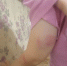 «На теле малышки 19 укусов»: мальчик покусал девочку в детском садике в Воронежской области - Bloknot-Voronezh.Ru