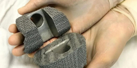 Пациентке в Сургуте поставили коленные импланты из 3D-принтера - РИЦ Югра