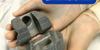 Сургутские врачи восстановили коленный сустав пациентки с помощью 3D-имплантов - ИА СИА-Пресс