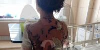 У семилетней девочки отслоилась кожа после лечения под Воронежем - Bloknot-Voronezh.Ru