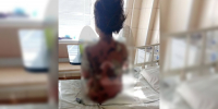 Историю с пострадавшей после лечения в Воронеже девочкой взял на контроль Бастрыкин - ГТРК Воронеж