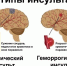 29 октября – Всемирный день борьбы с инсультом - Сетевое издание Ишимская правда