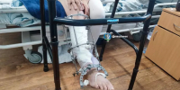 В Алапаевске врачи пришили женщине почти оторванную мотоблоком ступню - ОТВ